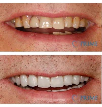 Full-Mouth Reconstruction  Dentist in Bridgewater, NJ